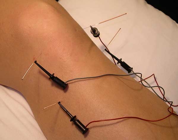 Electro-Acupuncture